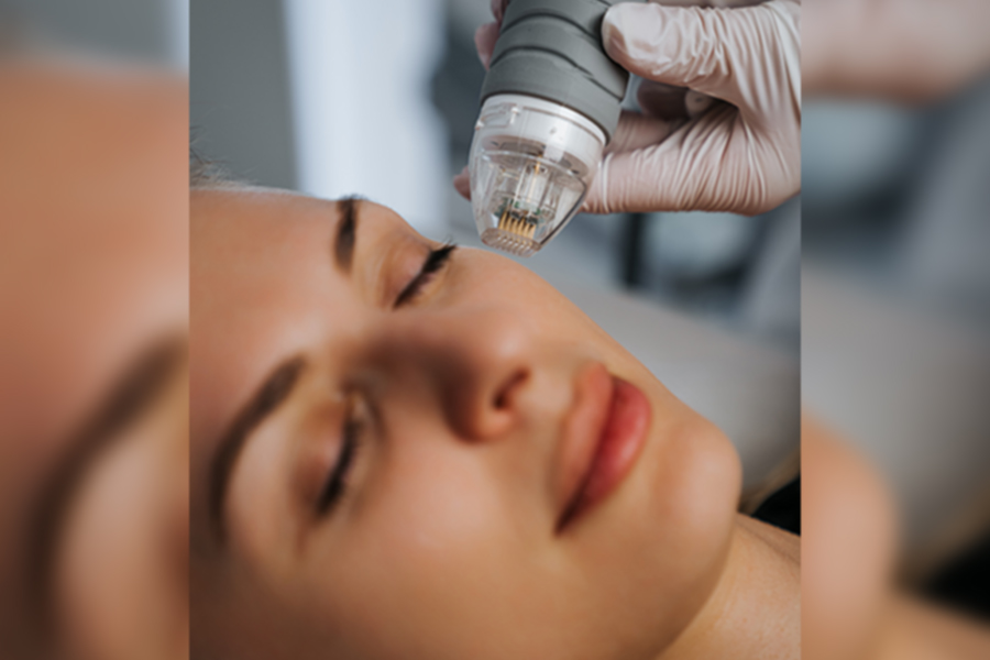 microneedling03